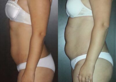 Resultado pérdida de grasa SandorFitness
